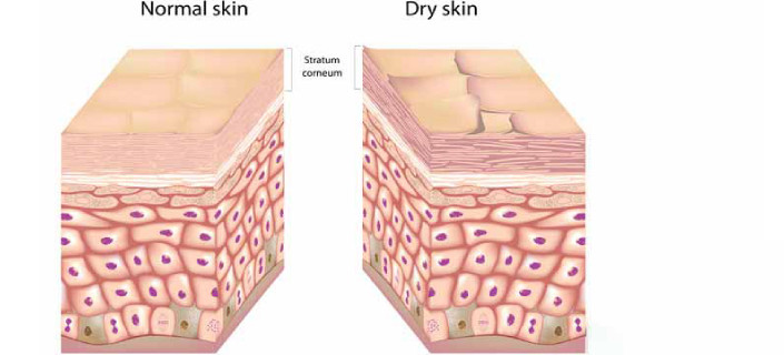 Skin Eczema